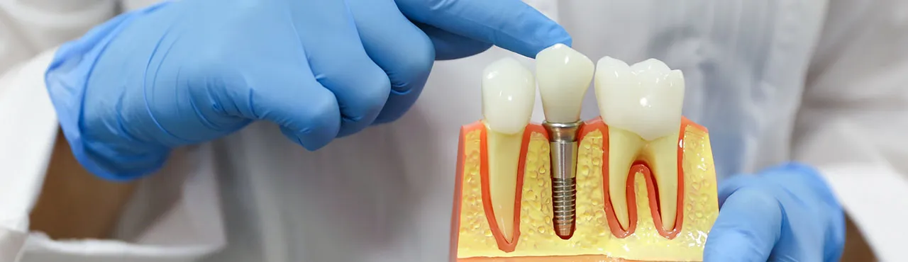 CD-Hands of a dentist doctor hold a model of teeth with a dental implant