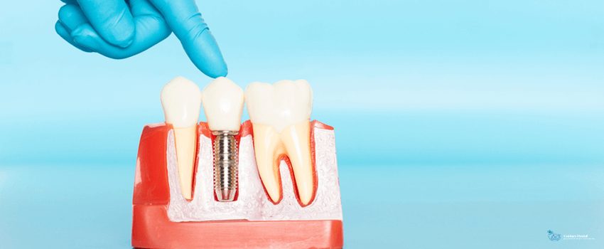 CD-Plastic samples of dental implants compare with natural teeth