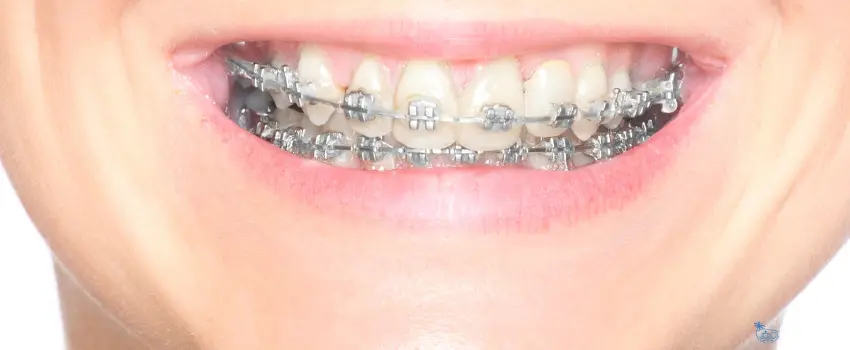 CD-Smiling woman with dental braces