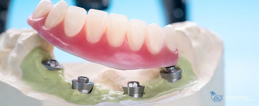 Everything You Need To Know About All-on-4 Dental Implants