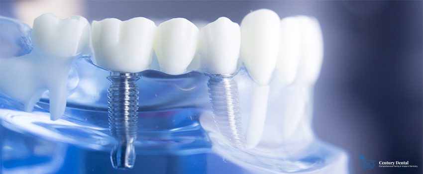 Everything You Need To Know About Implant Supported Dentures