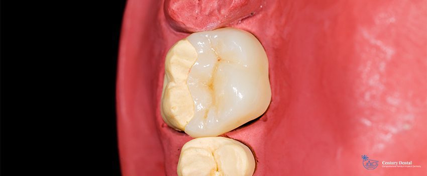 When Is Dental Onlay Better Than a Crown