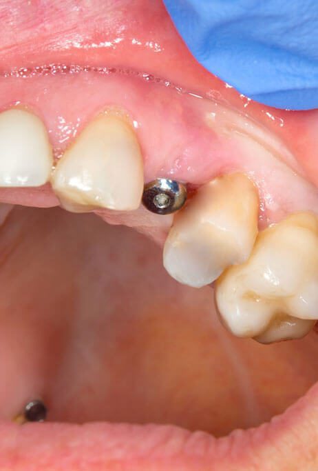 CD Top-Quality Dental Implants in Madeira Beach, FL